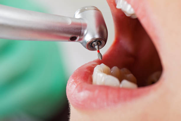 Best Emergency Dental Care for Broken or Chipped Teeth in Underwood Petersville, AL